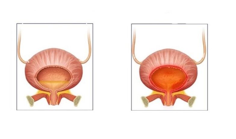 Φυσιολογικό και ασθενείς με λοίμωξη της ουροδόχου κύστης του ουροποιητικού συστήματος